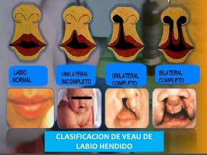 patologa-oral-del-recin-nacido-labio-y-paladar-hendido-17-728